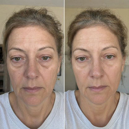 Under-Eye Red Light Therapy